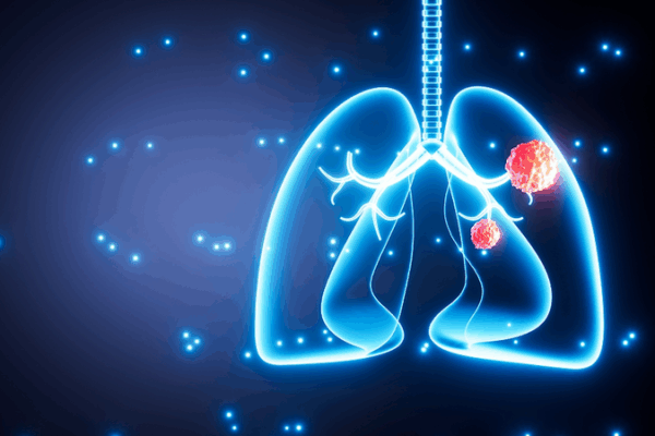 Study Reveals Air Pollution’s Role in Lung Cancer Mutations in Nonsmokers Study Reveals Air Pollution’s Role in Lung Cancer Mutations in Nonsmokers