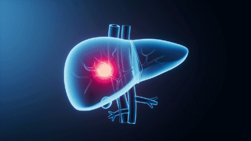 China-led Report Charts New Global Course for Liver Cancer Control China_led_Report_Charts_New_Global_Course_for_Liver_Cancer_Control
