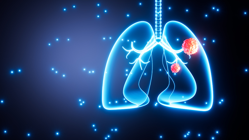 1 in 5 Lung Cancer Patients Are Nonsmokers, Study Says 1_in_5_Lung_Cancer_Patients_Are_Nonsmokers__Study_Says
